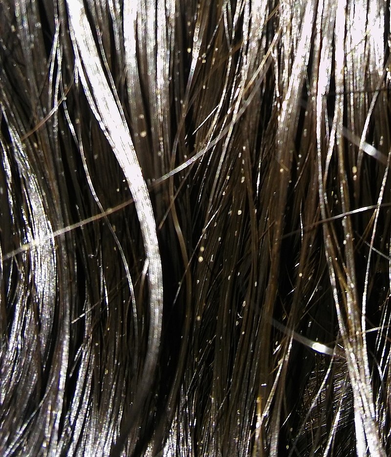 Trichosporon beigelii image