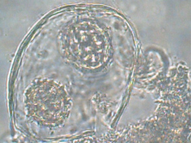 Tuber excavatum image