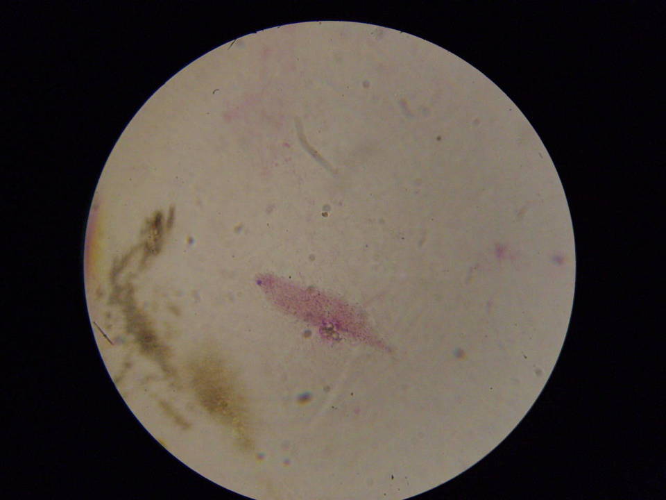 Blastomyces dermatitidis image